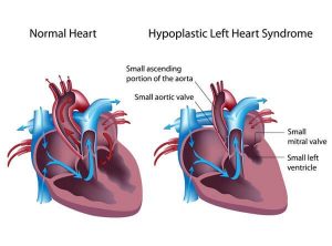 hypoplastic-left-heart-syndrome