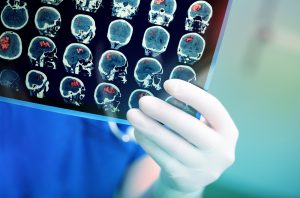 Abogados de Lesiones Cerebrales Traumáticas en Chicago